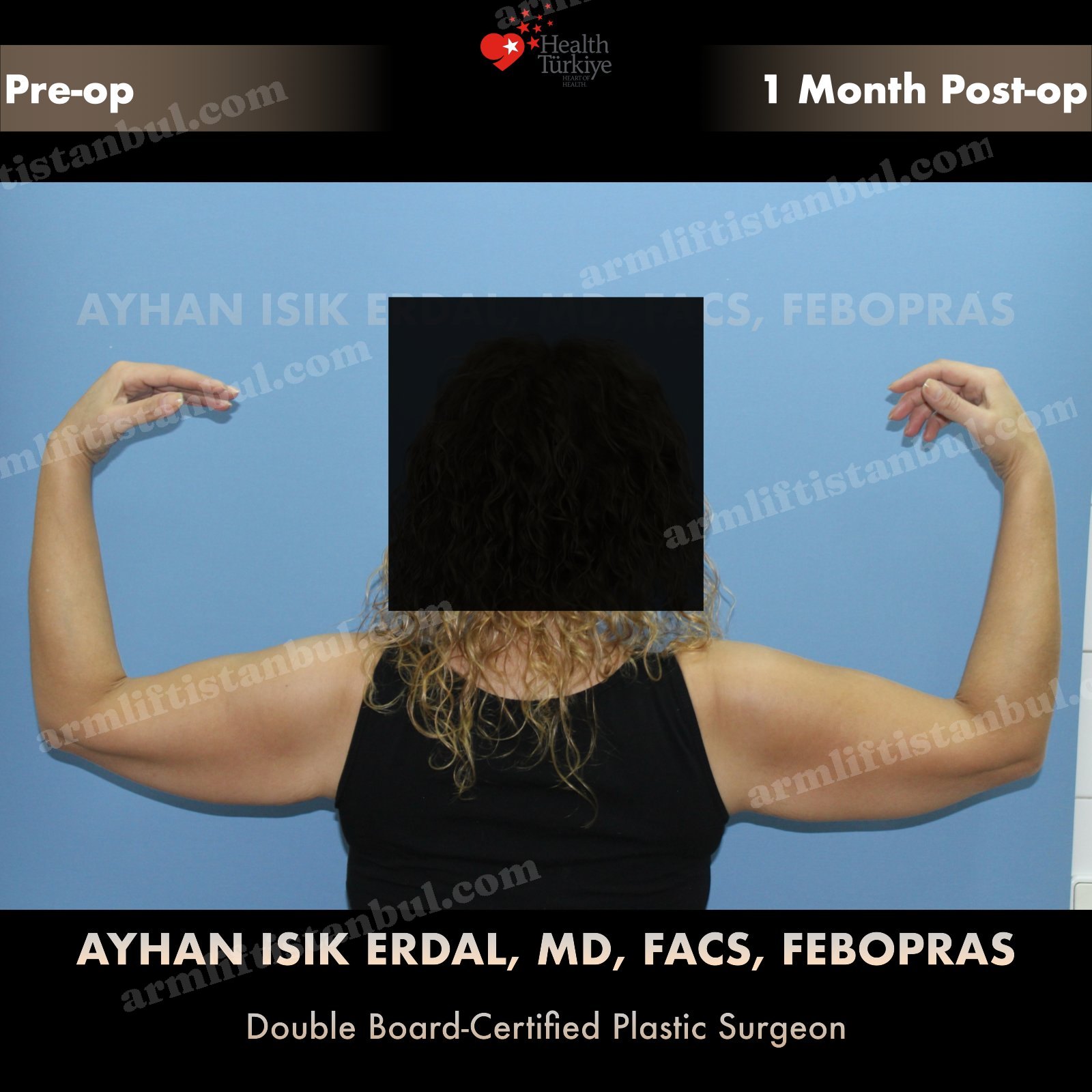 Arm lift before and one month post-op, posterior view — patient of Dr. Ayhan Işık Erdal