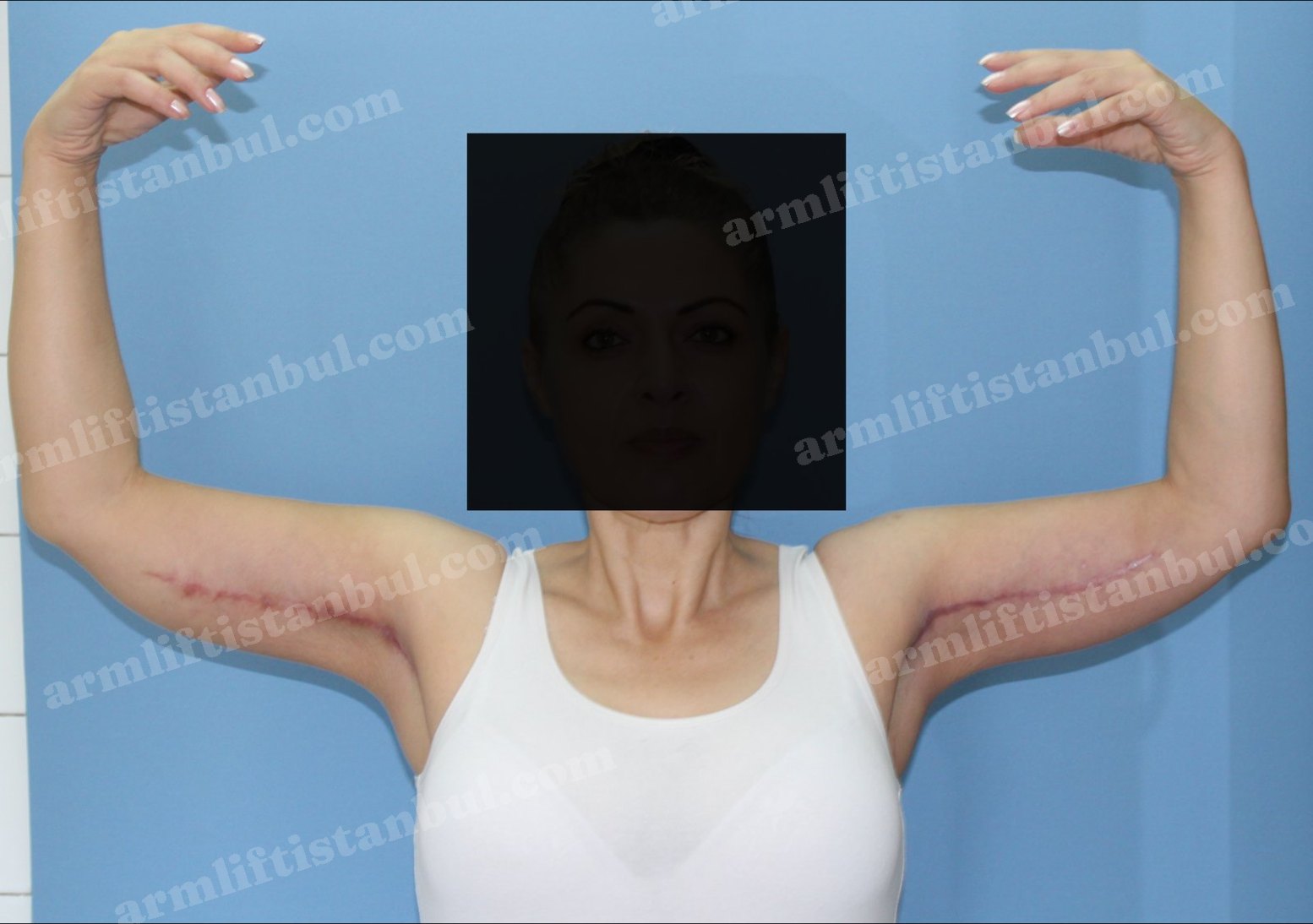 Arm lift after — Front view