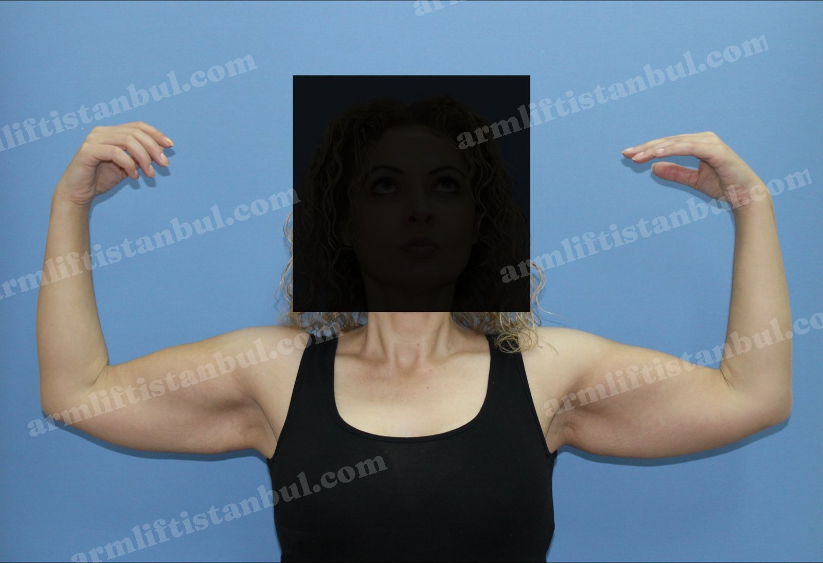 Arm lift before — Front view