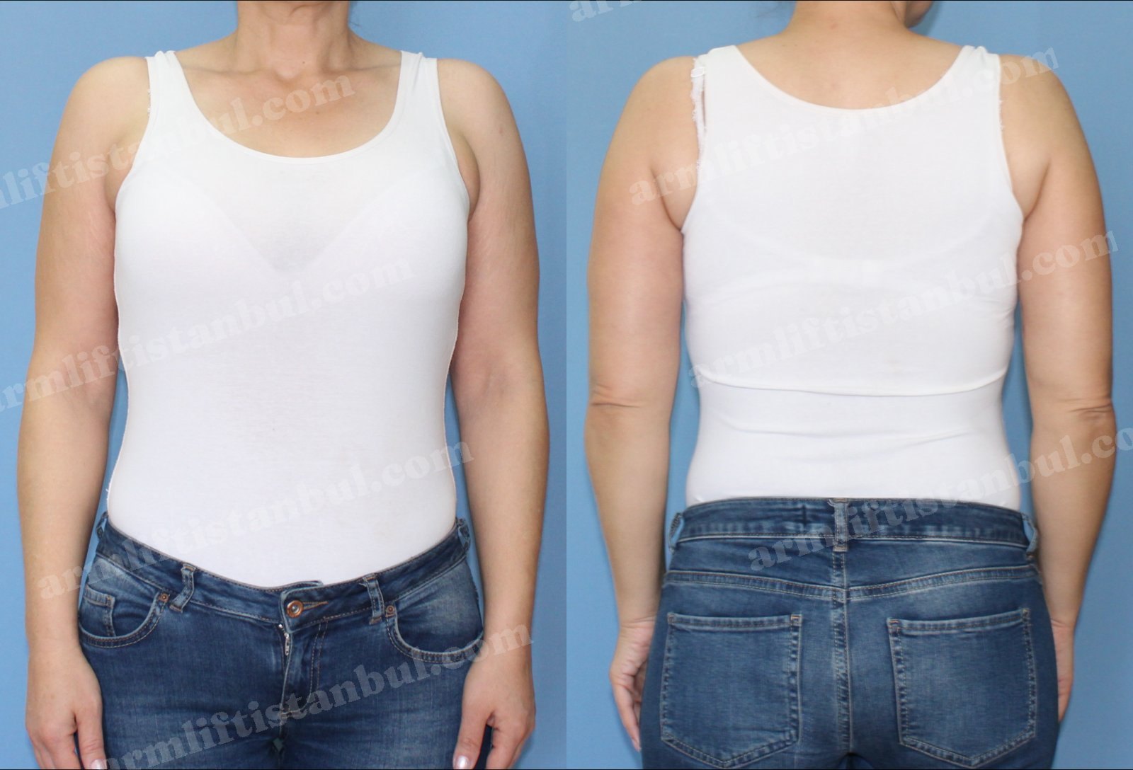 Arm lift result — Upper body